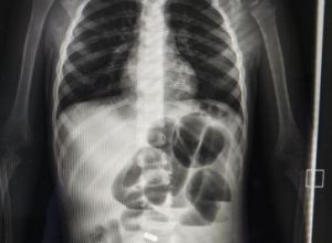 В Туле хирурги спасли двухлетнего ребенка, проглотившего магниты