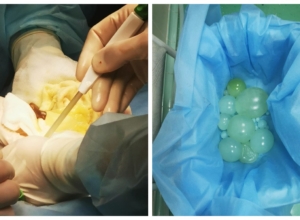 У туляка резко вырос живот: шесть лет он не мог понять, что с ним происходит